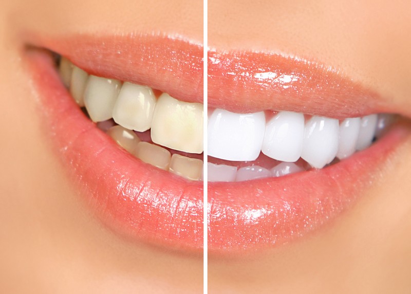Teeth Whitening  Salem, UT 